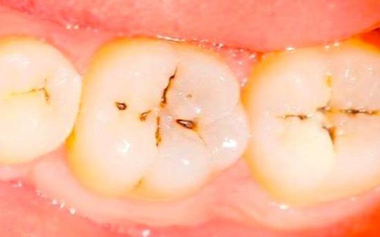 پوسیدگی و خرابی دندان درمان خانگی دارد؟